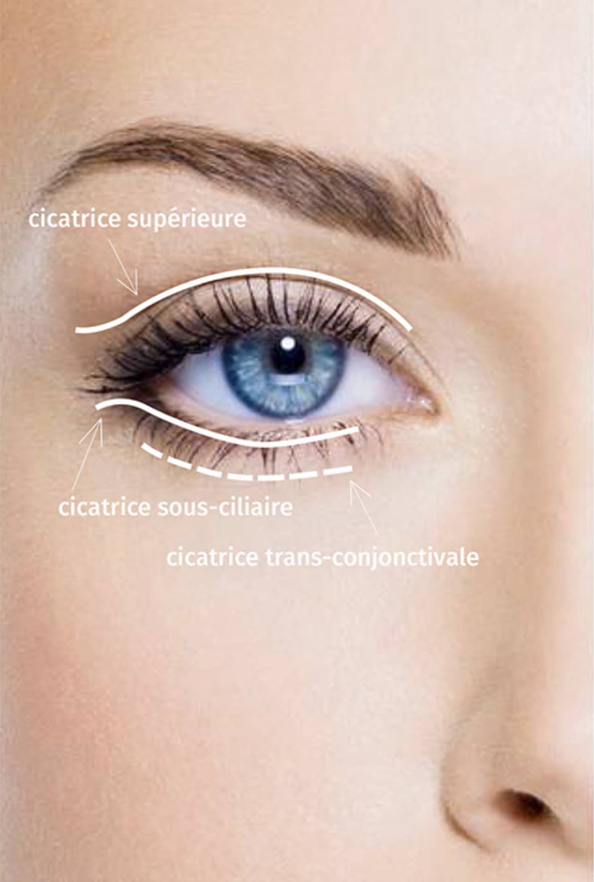 Blépharoplastie, chirurgie des paupières CECAM