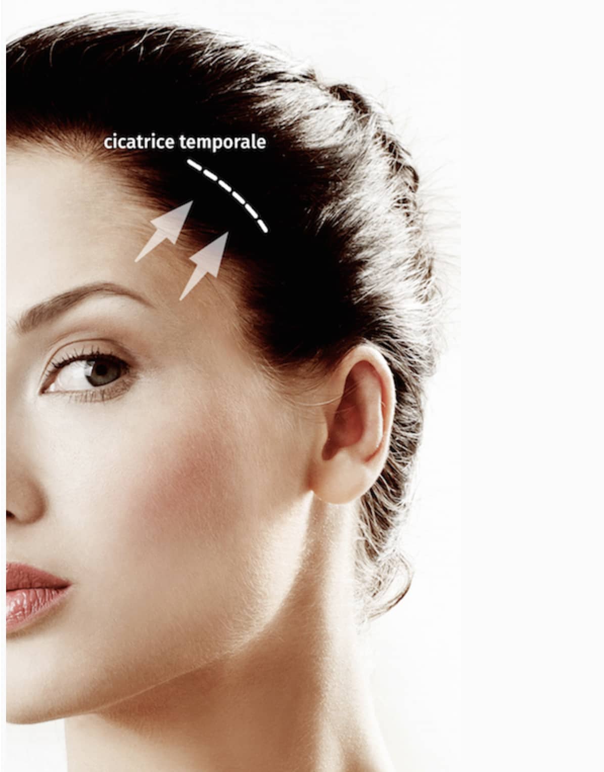 Lifting temporal des sourcils