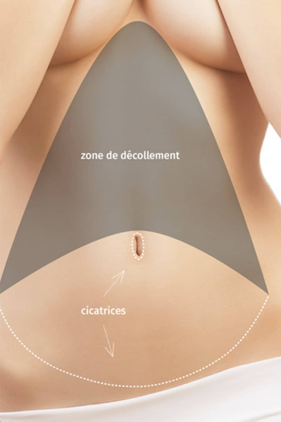 Blépharoplastie, chirurgie des paupières CECAM