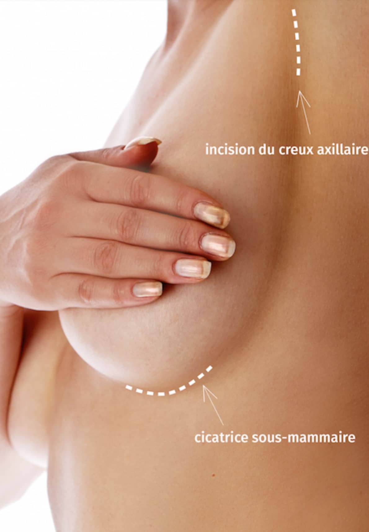 Augmentation mammaire CECAM Cannes Mougins