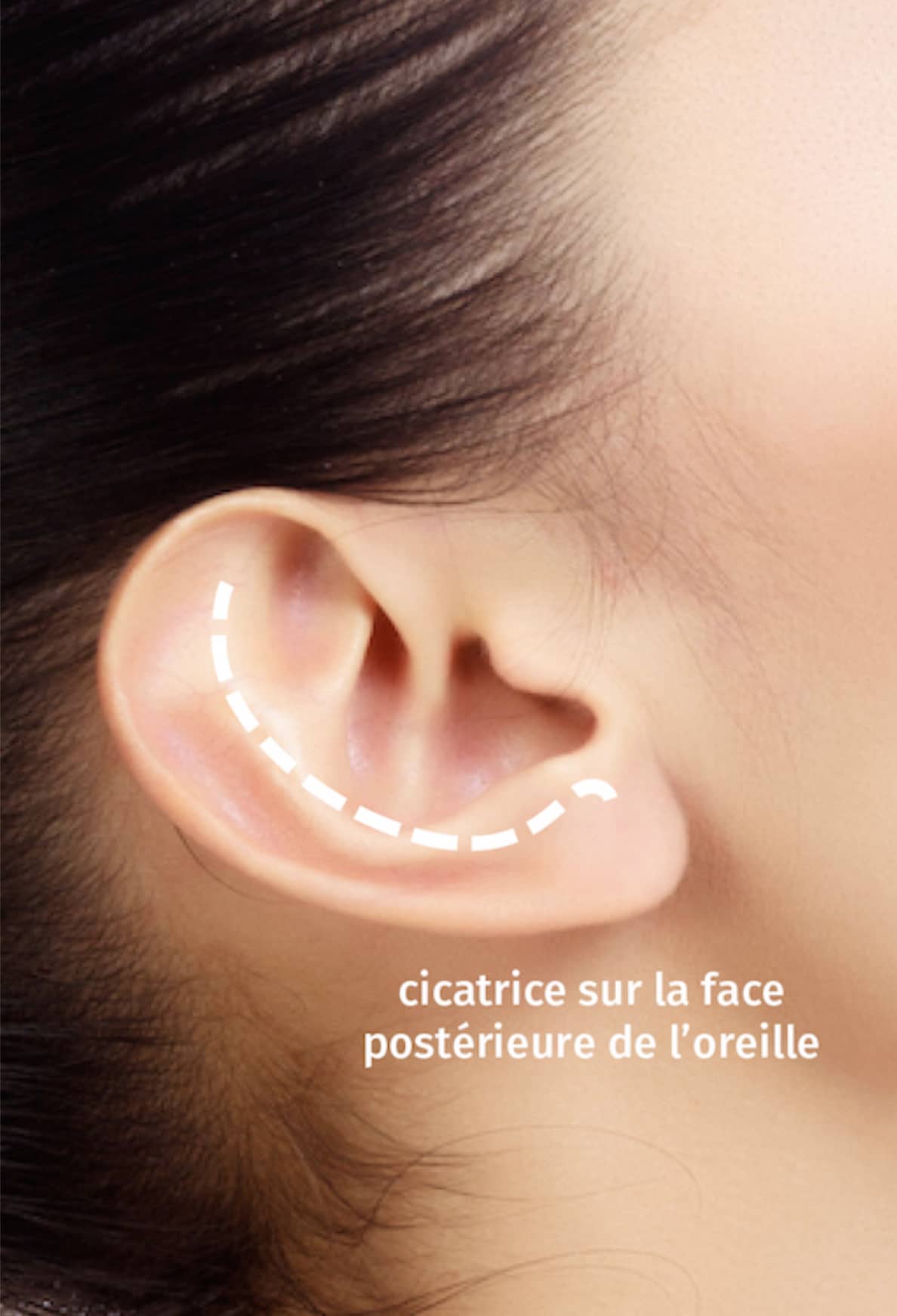 Blépharoplastie, chirurgie des paupières CECAM