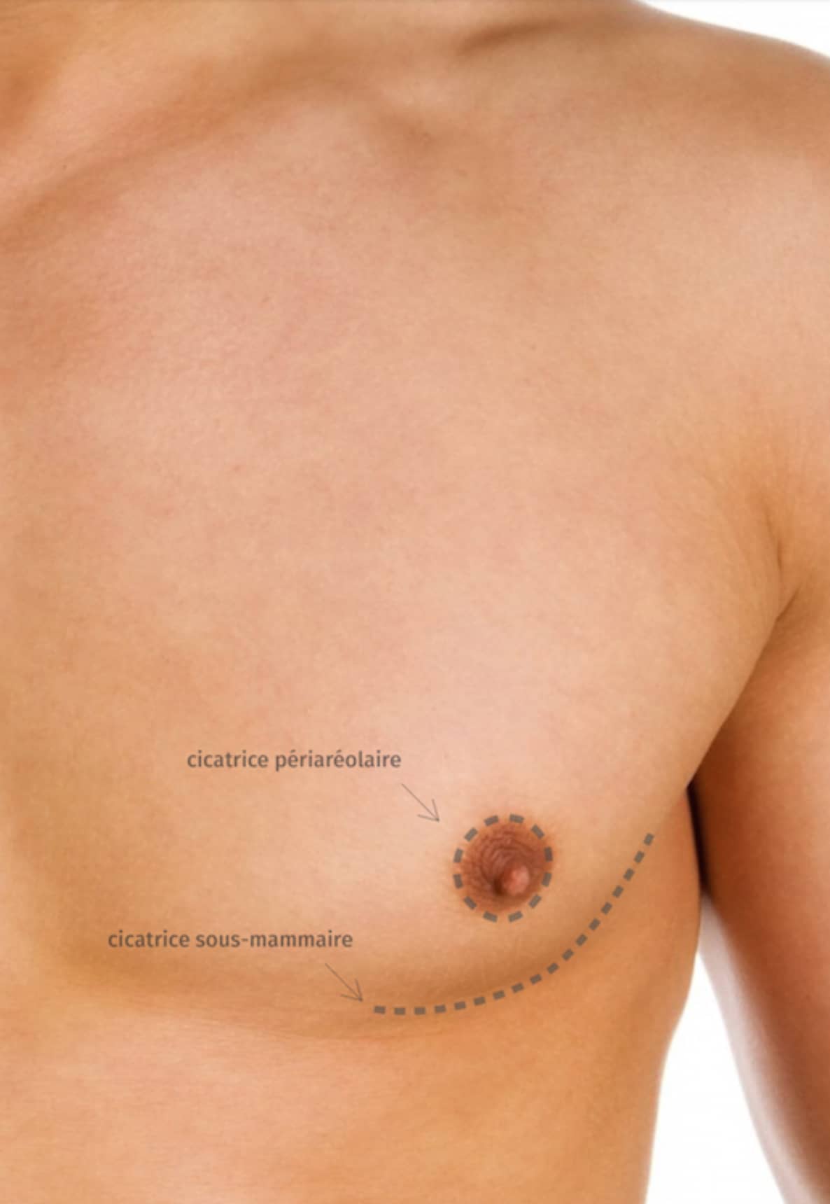 Blépharoplastie, chirurgie des paupières CECAM