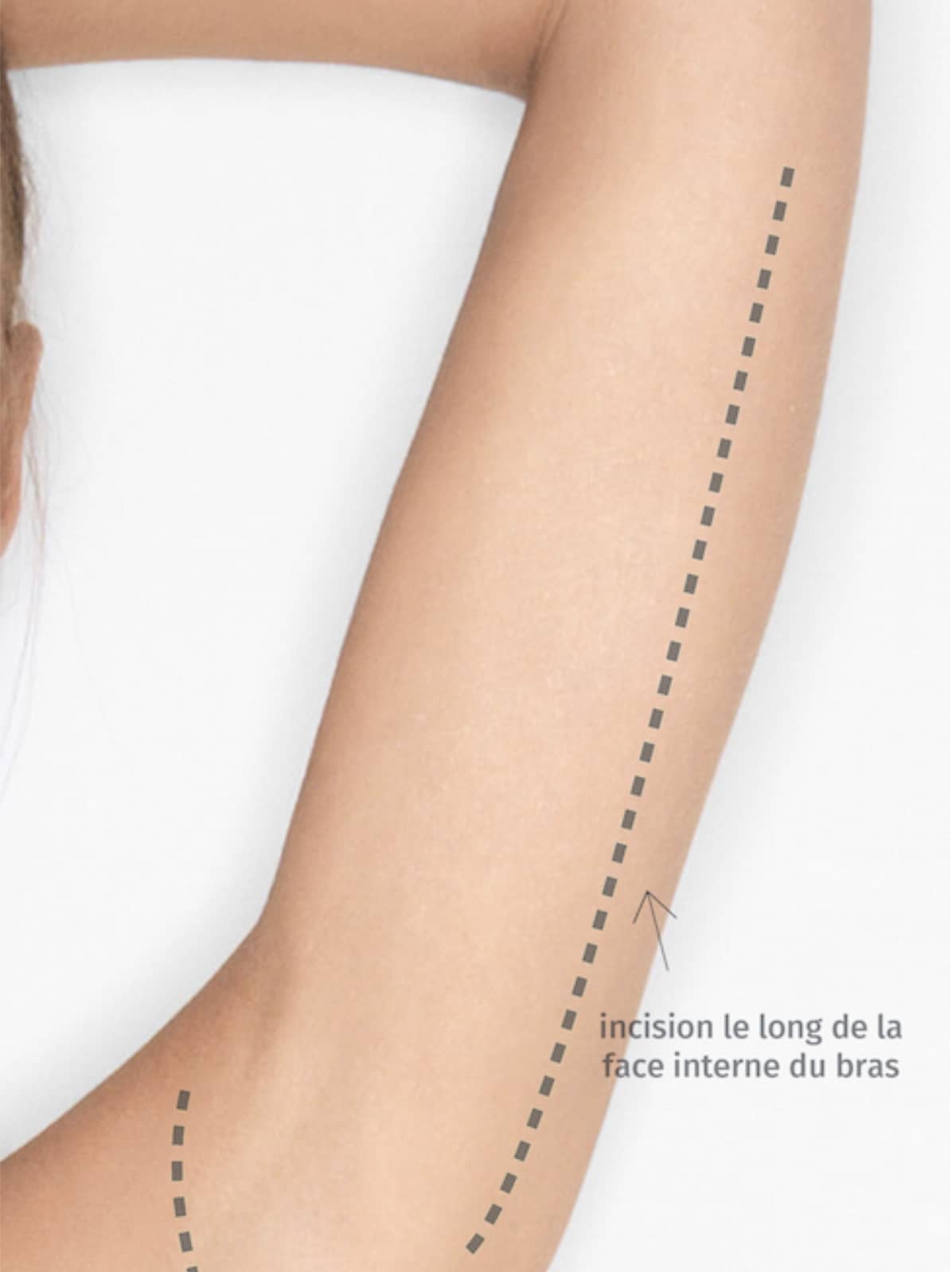 Blépharoplastie, chirurgie des paupières CECAM
